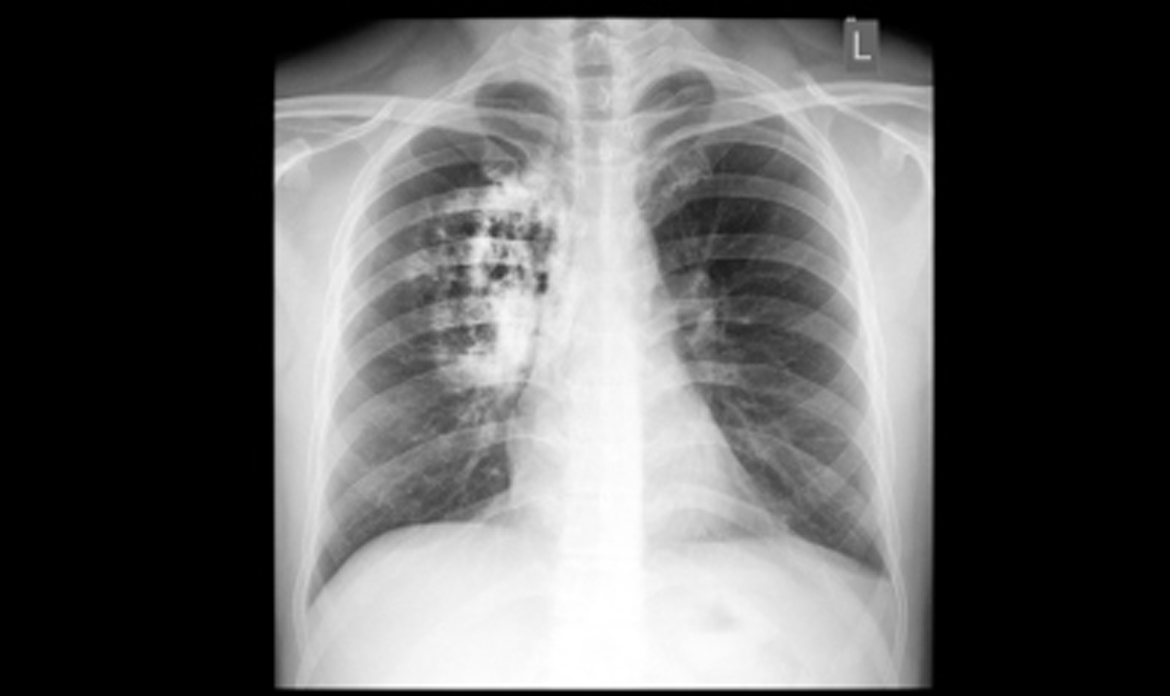 IS FIBREGLASS INSULATION DANGEROUS